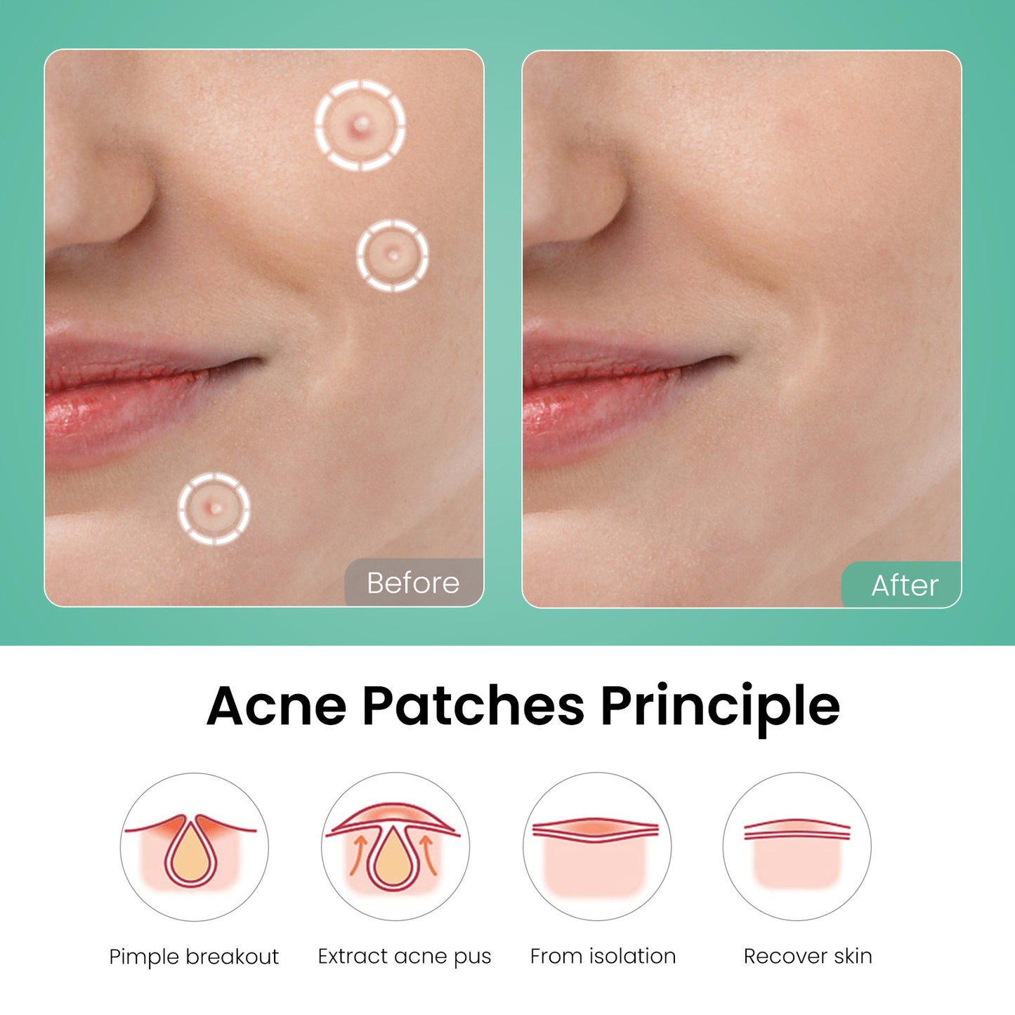 Nozibye 443Pcs Acne Patch Translucent Hydrocolloid Pimple Patches for full-face Blemish Care-Gently Absorbs Gunk- Strong Adhesion-Shields Skin-Ultra-Thin & Cozy-Day & Night Use - Sensitive Skin Safe - Premium Hydrocolloid - 5 Size Pack