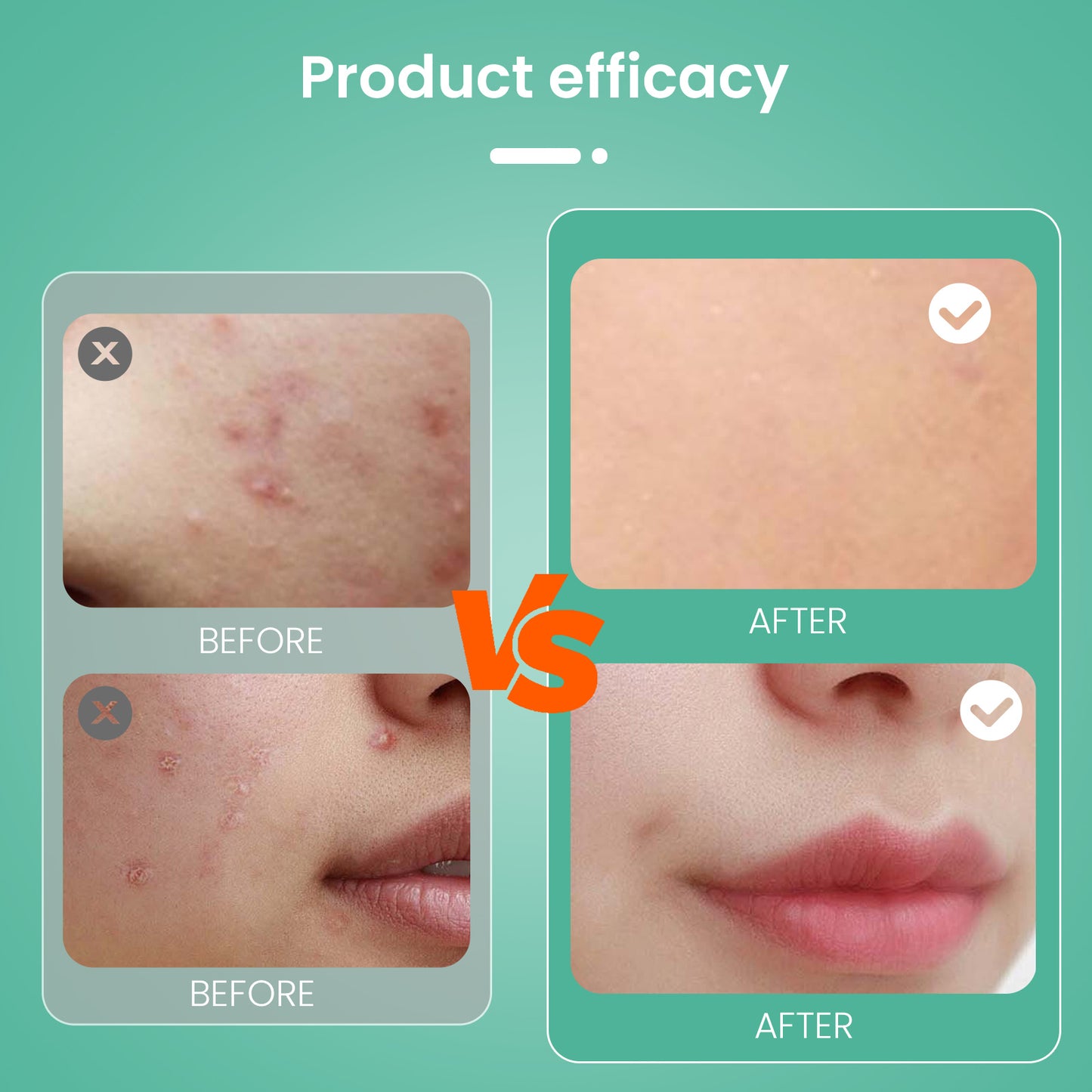Nozibye 443Pcs Acne Patch Translucent Hydrocolloid Pimple Patches for full-face Blemish Care-Gently Absorbs Gunk- Strong Adhesion-Shields Skin-Ultra-Thin & Cozy-Day & Night Use - Sensitive Skin Safe - Premium Hydrocolloid - 5 Size Pack
