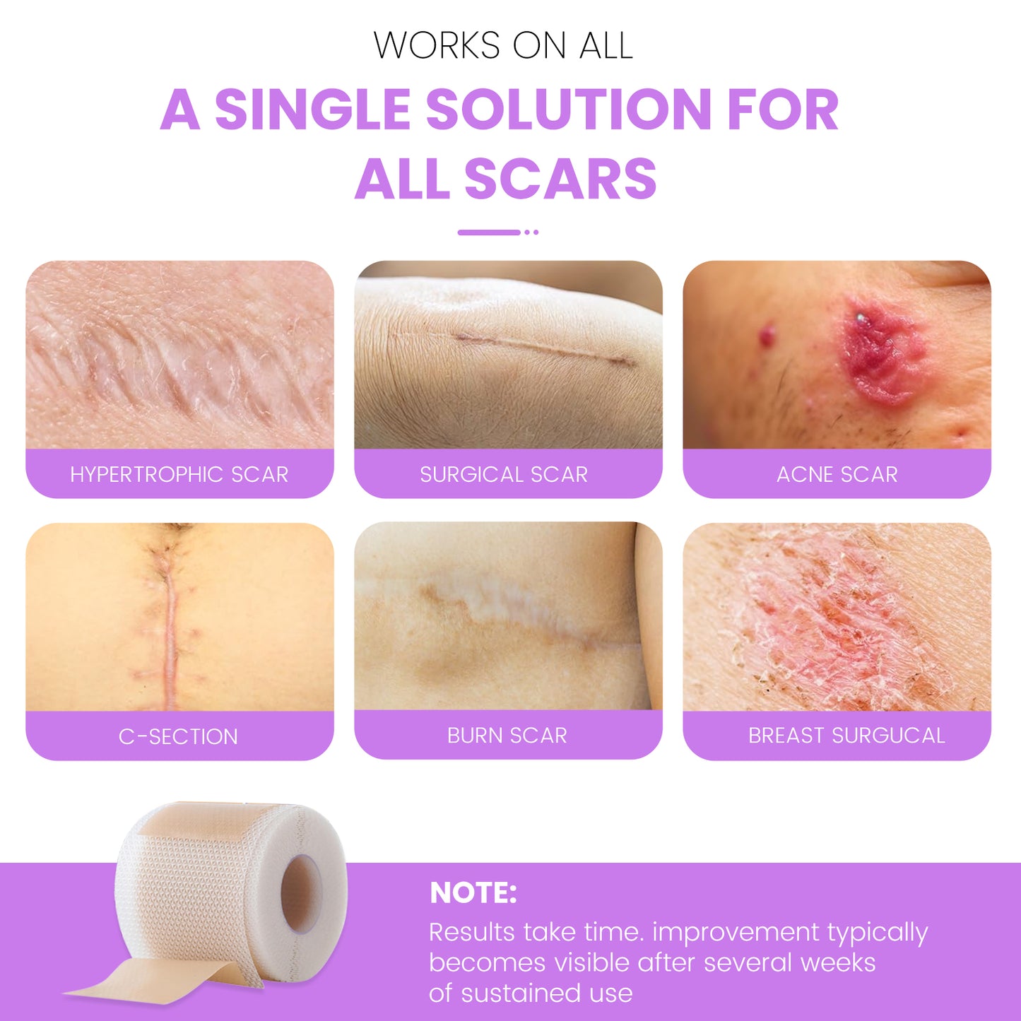 Nozibye Medical Grade Silicone Scar Sheets & Tape Roll for Keloids & Old Scars - Perforated Strips Every 6cm, No Scissors Needed | 4x300cm Large Roll | Reusable & Washable | Fades C-Section, Surgery, Burn, Acne Scars