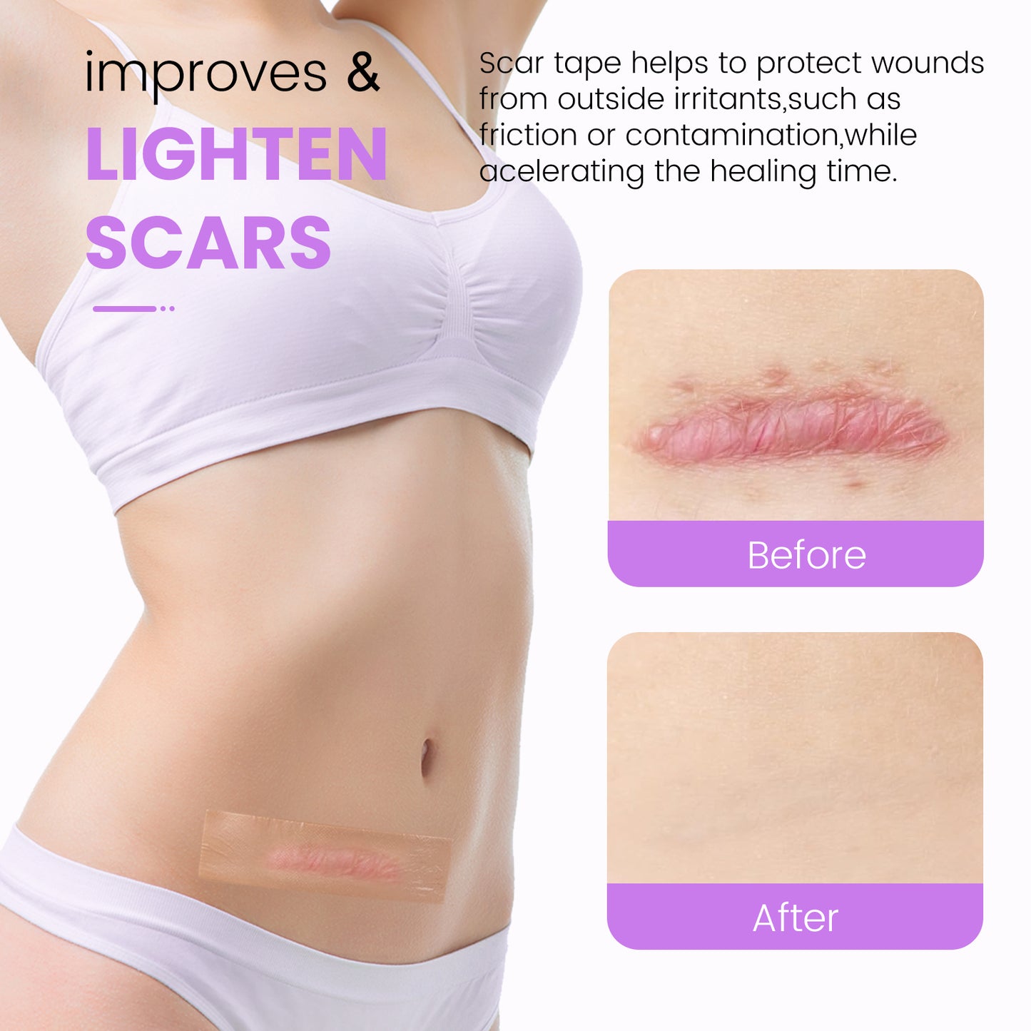 Nozibye Medical Grade Silicone Scar Sheets & Tape Roll for Keloids & Old Scars - Perforated Strips Every 6cm, No Scissors Needed | 4x300cm Large Roll | Reusable & Washable | Fades C-Section, Surgery, Burn, Acne Scars