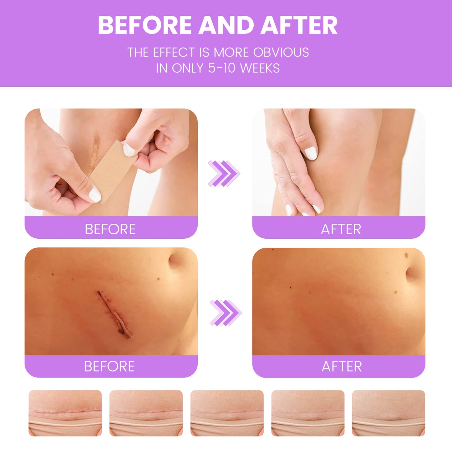 Nozibye Medical Grade Silicone Scar Sheets & Tape Roll for Keloids & Old Scars - Perforated Strips Every 6cm, No Scissors Needed | 4x300cm Large Roll | Reusable & Washable | Fades C-Section, Surgery, Burn, Acne Scars